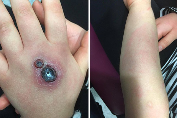 Menina de 8 anos de idade enfrenta cirurgia e noites no hospital após picada de aranha marrom