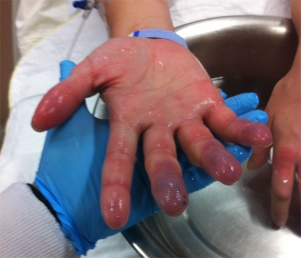 Após ficar três horas desacordada no frio canadense, jovem quase perde os dedos