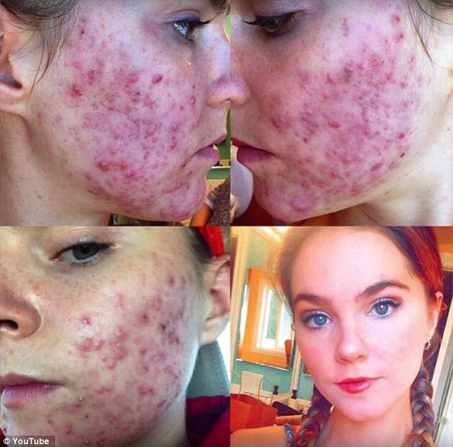 Gêmeas conseguem acabar com acne severa apenas com mudança na alimentação