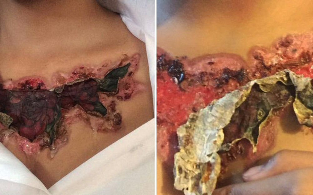 remo&ccedil;&atilde;o-tatuagem-03