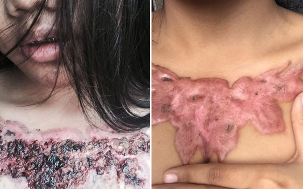 remo&ccedil;&atilde;o-tatuagem-04