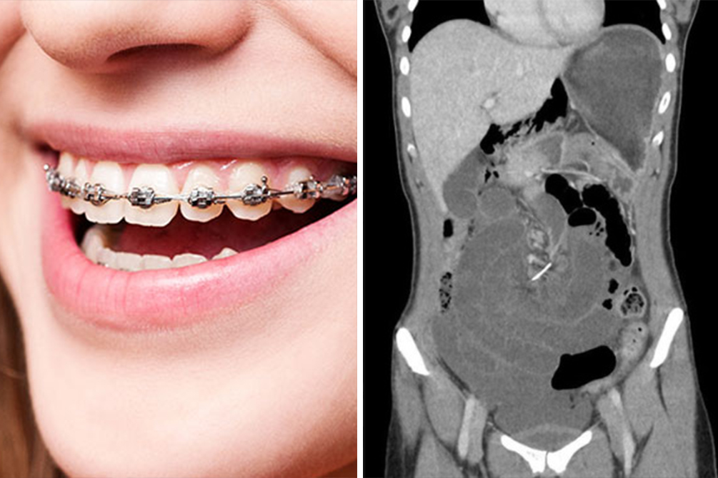 Dez anos após tirar aparelho, mulher descobre fio no intestino
