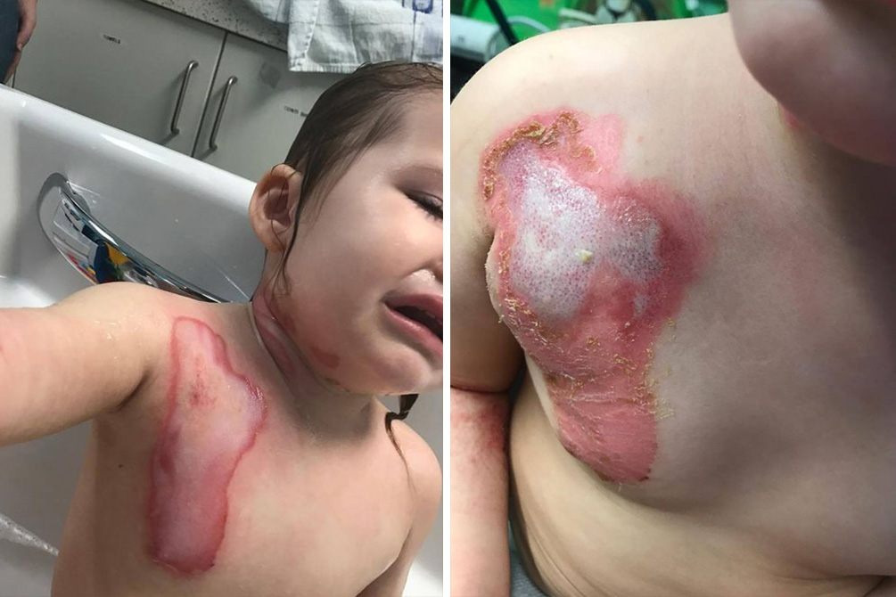 pai-acidente-queimadura-03