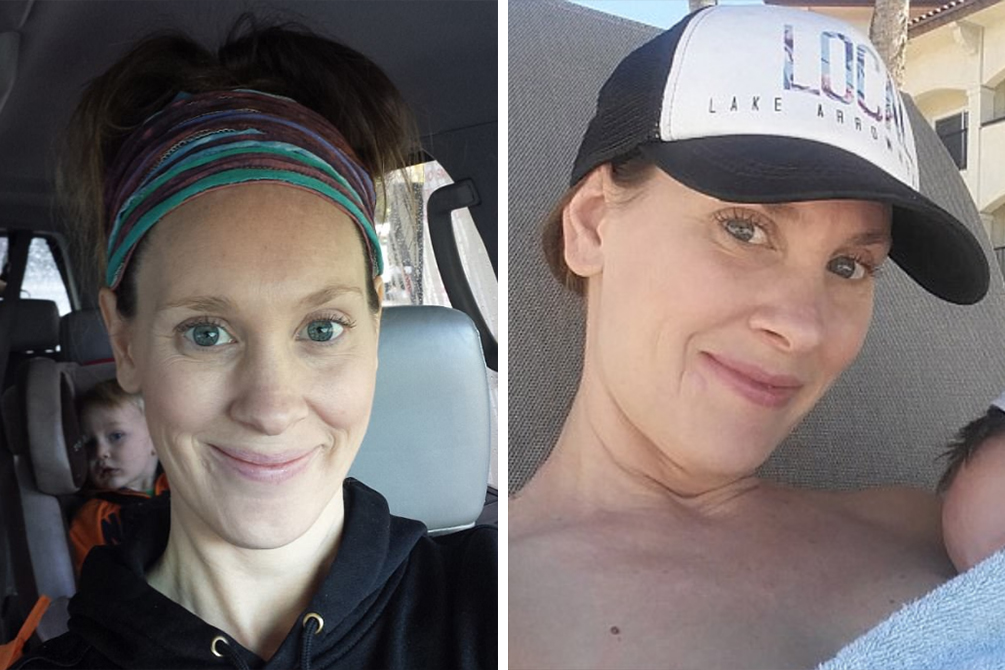 Após confundir câncer com espinha, mulher faz alerta sobre doença