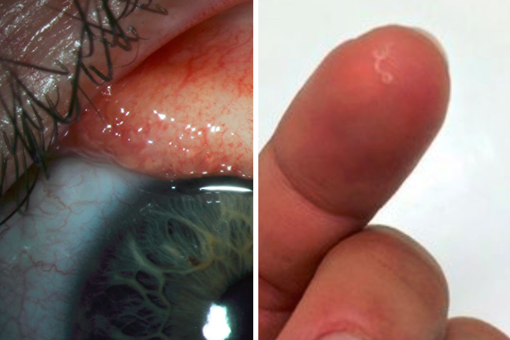 mulher-vermes-olho-01