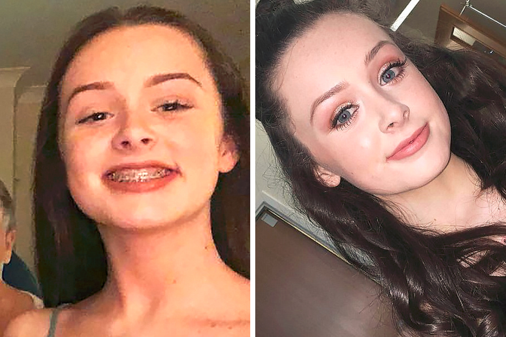 Jovem de 15 anos sofre derrame uma semana após visita ao dentista