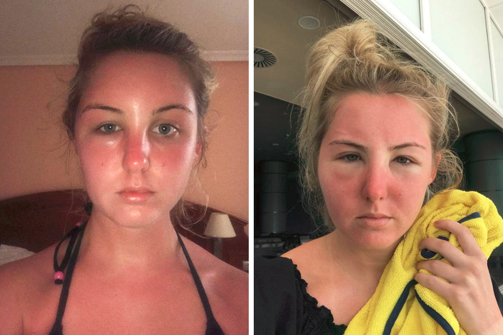 intoxicacao-solar-04