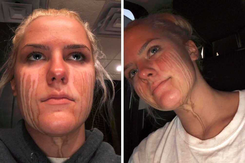 arrependimento-bronzeamento-artificial-03