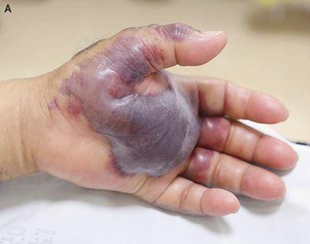 sushi-braco-amputado-01