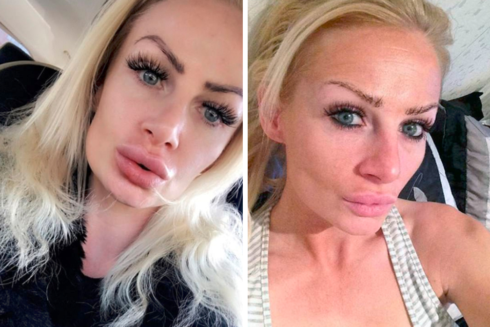 Mulher faz alerta após resultado de popular procedimento estético