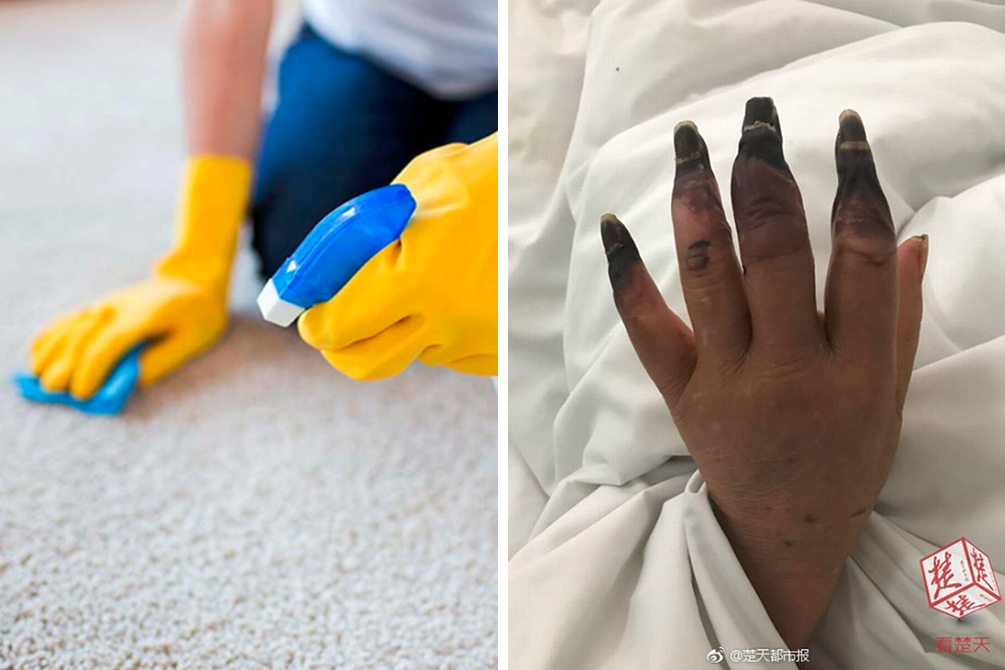 Dedos de mulher ficam pretos após acidente doméstico comum durante faxina