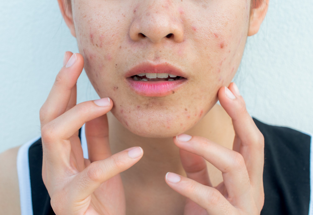Maskne, a acne que pode surgir com o uso de máscara