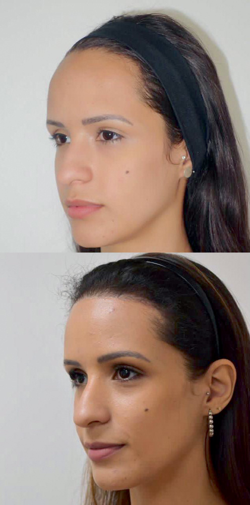 novos-procedimentos-estéticos-renata-marques-frontoplastia.jpeg antes (acima) e depois (abaixo) de cirurgia de redução de testa na Renata Marques