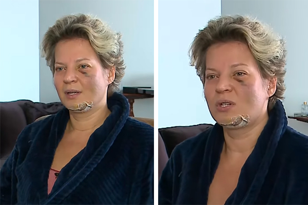 Montagem mostra dois frames de entrevista de Joice para o SBT: ela aparece com roupão e curativo na região do queijo, além de olho roxo