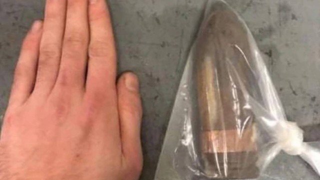 Hospital chama esquadrão antibombas para homem com projétil no ânus