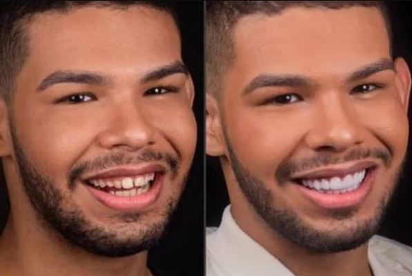 imagem duplas: o ex-BBB vini colocou lentes de contato brancas nos dentes
