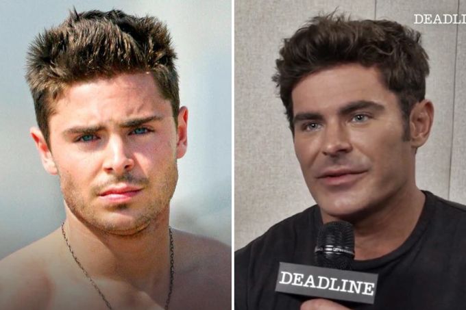 Montagem com foto de Zac Efron antes de acidente e depois, com queixo avantajado.