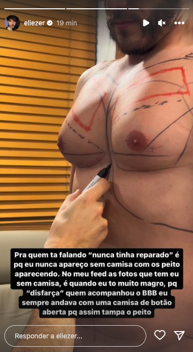 a imagem mostra as mamas de eliezer com marcações de caneta feitas por um médico cuja mão aparece na foto