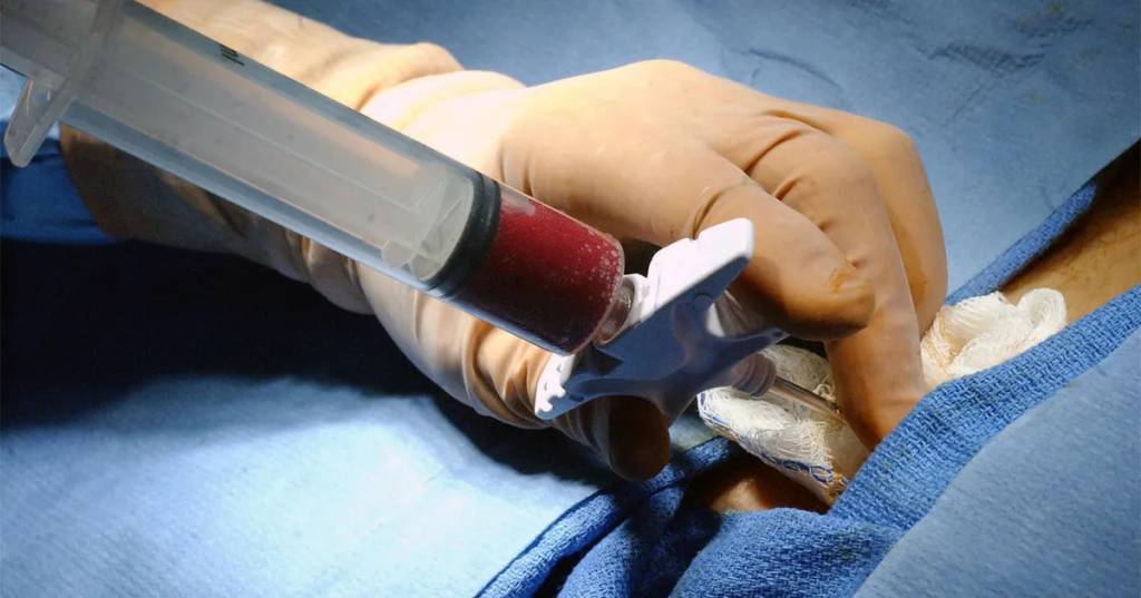 Saiba como se tornar um doador de medula óssea em SP