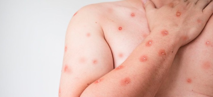são-paulo-tem-mais-de-500-casos-de-mpox-em-2024